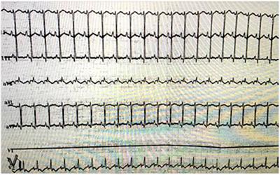 Ventricular Septal Rupture After Blunt Chest Trauma in an Infant: A Case Report and Mini-Review